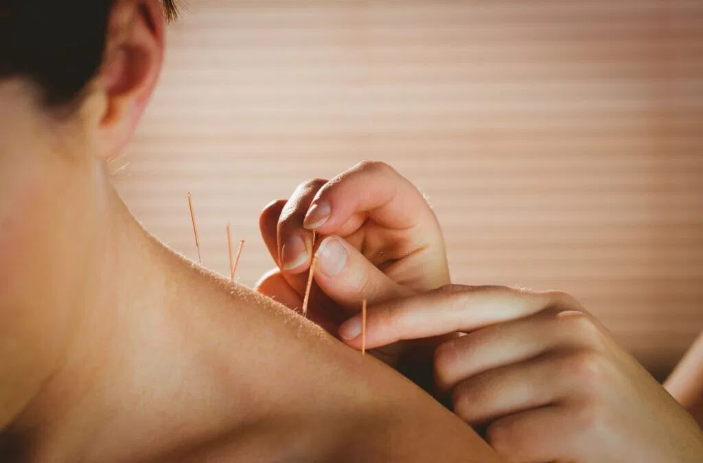 Understanding Dry Needling: A Comprehensive Guide