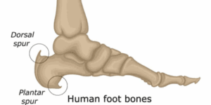 Heel Spurs:  What are they and what can I do to get rid of them?