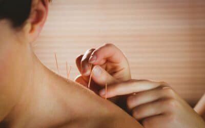 Understanding Dry Needling: A Comprehensive Guide